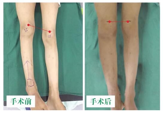 女孩墜梯右腿縮短5cm，幸得醫(yī)生及時診治恢復(fù)正常腿型