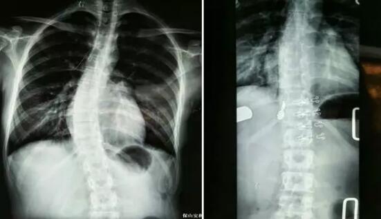 好好的脊柱怎么說彎就彎了？你竟然都沒發(fā)現(xiàn)……