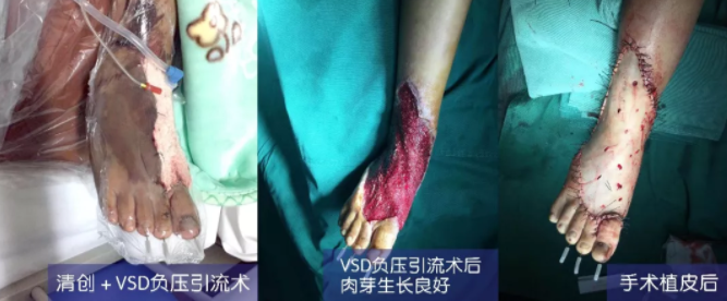 車禍猛如虎，救治如“華佗” ，手術(shù)＋康復(fù)，8歲小女孩車禍后日漸康復(fù)行走