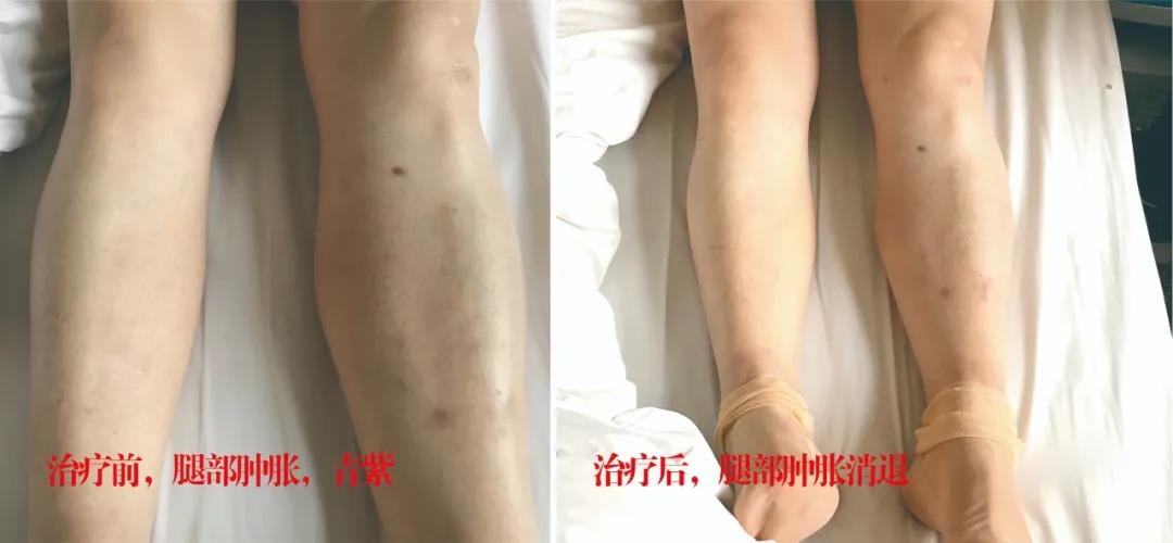 下肢靜脈血栓多年頑疾反復(fù)腫痛——疾病不容等待，早治療，早健康！
