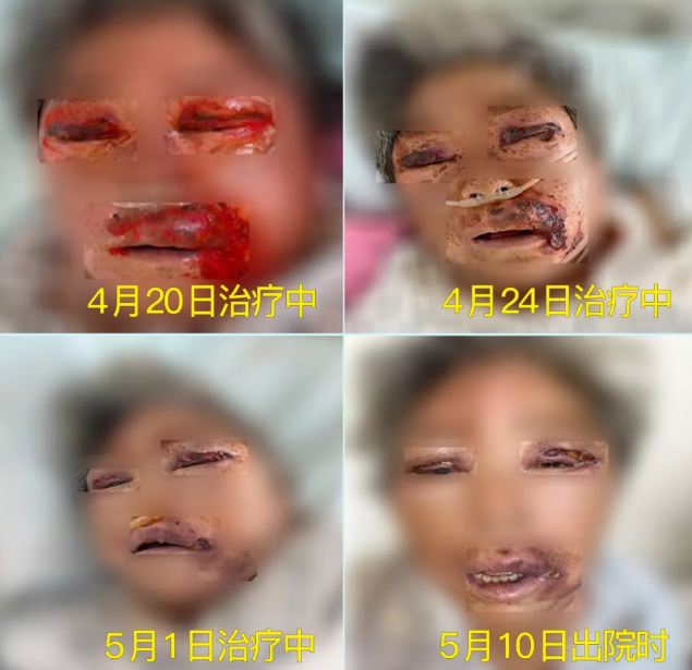 膿毒血癥（急性頜面部蜂窩組織炎）多學(xué)科聯(lián)合會(huì)診，幫助患者成功治愈！
