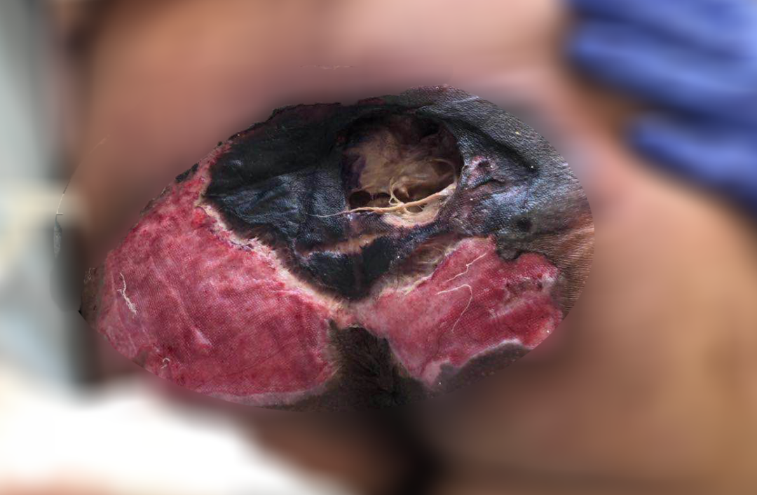 癱瘓3年的女患者臀部居然變成這樣?！