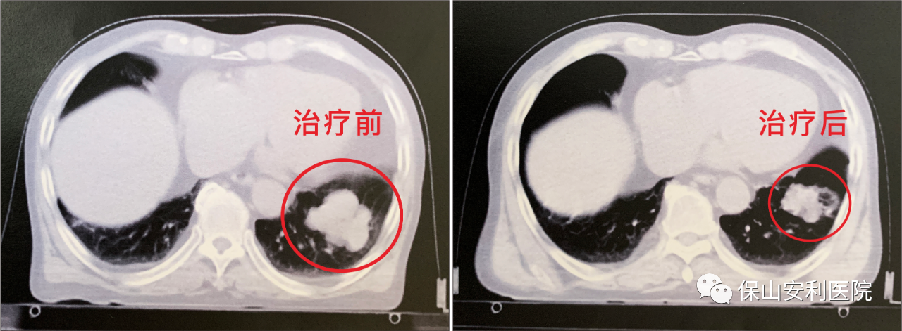 不做手術(shù)，早期肺癌也能根治！