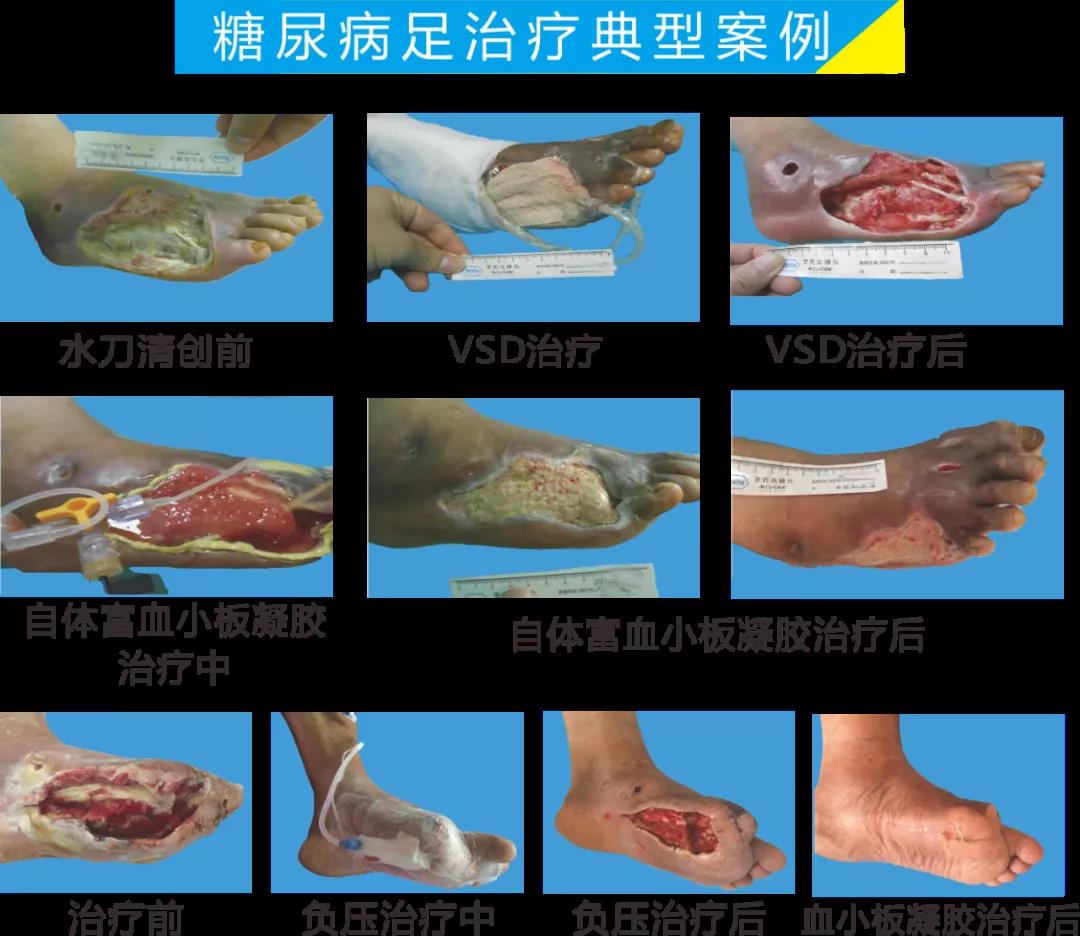 截肢、失明，甚至……，我們要做的是將糖尿病并發(fā)癥遏制在搖籃里！