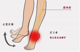 【保山安利醫(yī)院—健康科普】什么是足下垂！你了解嗎？