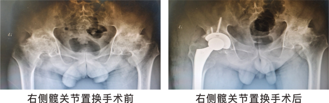 【保山安利醫(yī)院】長期飲酒導(dǎo)致雙側(cè)股骨頭壞死，髖關(guān)節(jié)置換后重獲運動功能！