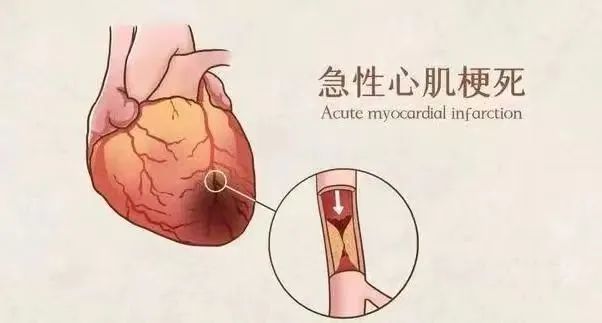 【保山安利醫(yī)院】11月20日“心梗救治日” 時(shí)間就是心肌，時(shí)間就是生命！